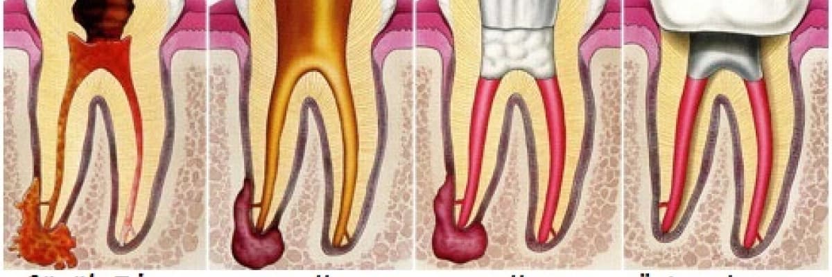 İnatçı Enfeksiyonlar Kanal Tedavisi ve Apikal Rezeksiyon