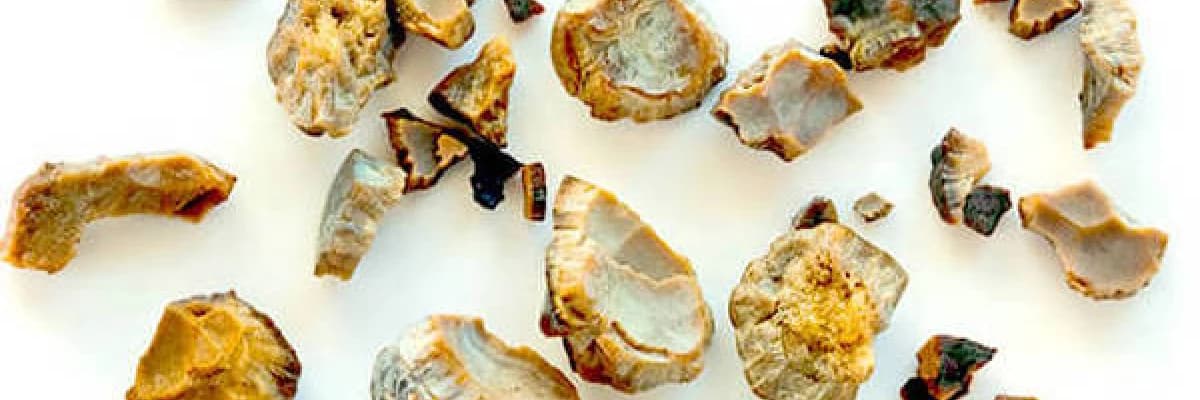 Böbrek taşı hakkında doğru bilinen yanlışlar