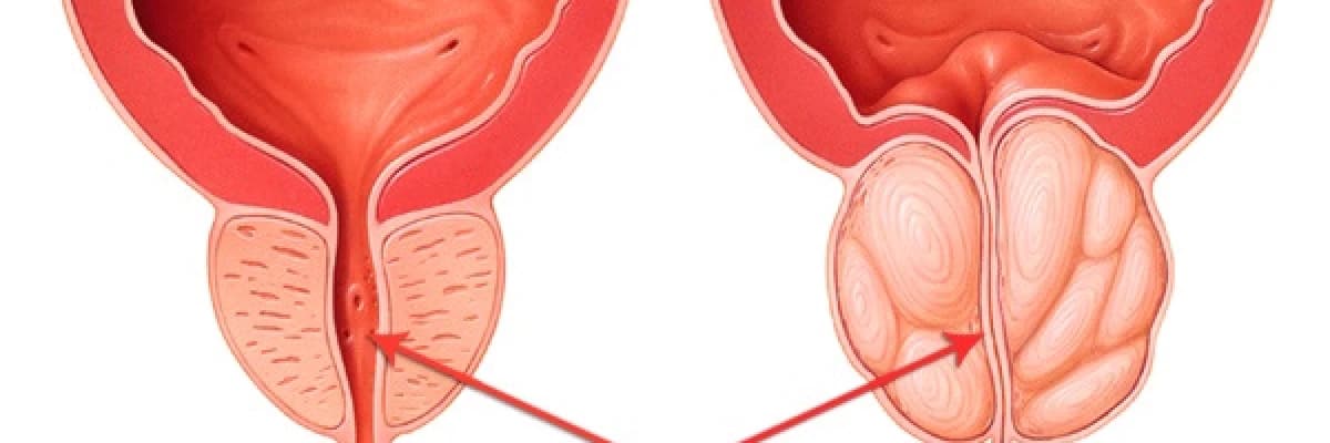 BPH (İyi Huylu Prostat Büyümesi)