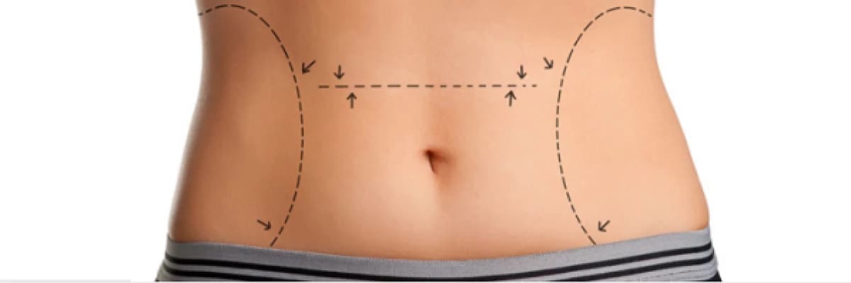 Karın Germe (ABDOMİNOPLASTY) Operasyonu Hakkında