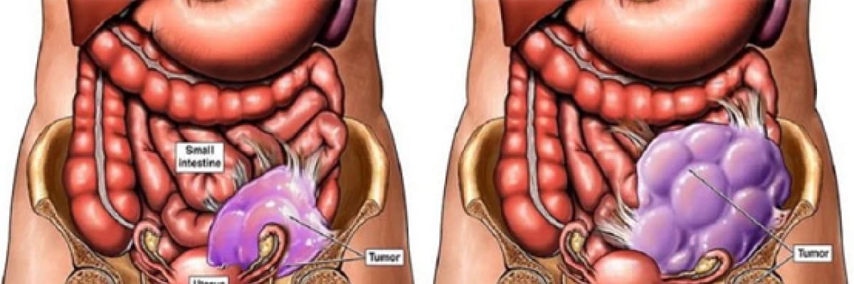 RAHİM AĞZI KANSERİ HAKKINDA BİLMENİZ GEREKENLER