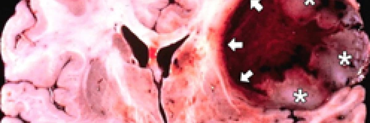 Kötü Huylu Beyin Tümörleri