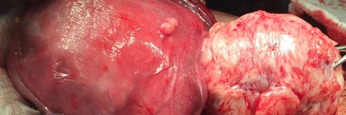 Miyoma Uteri (Rahimde Ur) Hakkında Merak Ettikleriniz