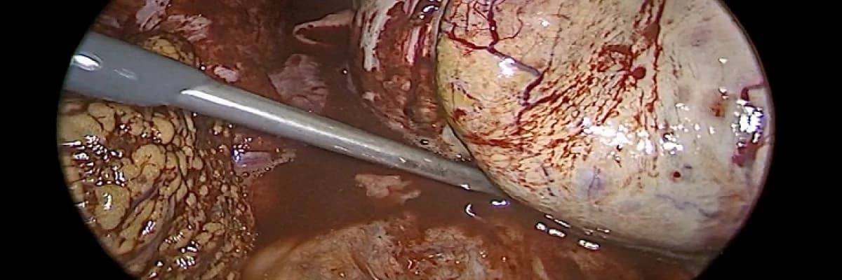 Çikolata Kisti Hakkında Merak Ettikleriniz