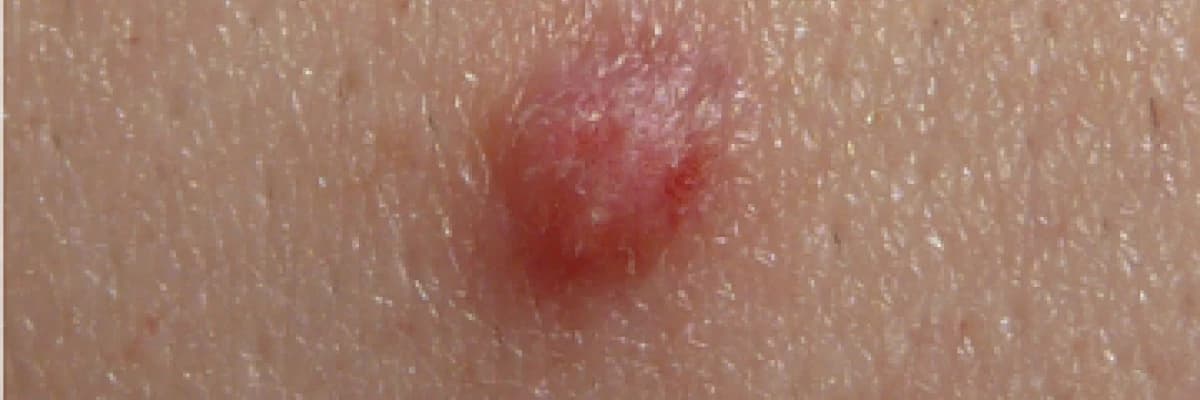 Genital Siğil Tedavisi