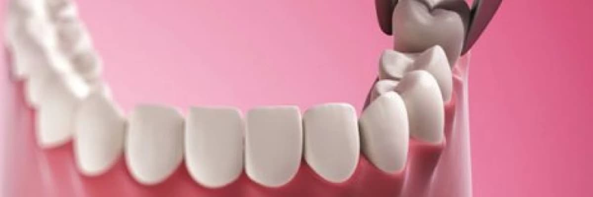 Yirmilik diş operasyonu