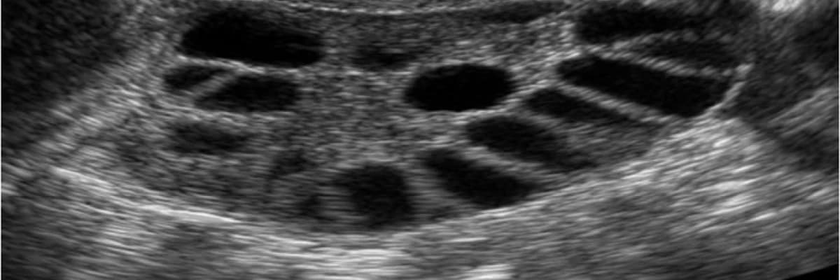 Polikistik Over Sendromu Olan Kadınlar Risk Altında mıdır?