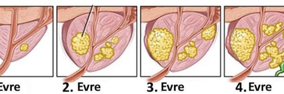 Prostatin iyi huylu büyümesi ve prostat kanseri