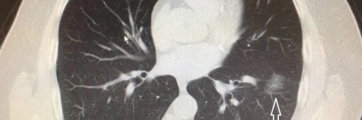 BİR BU TABİR EKSİKTİ – AKCİĞERDE NODÜL