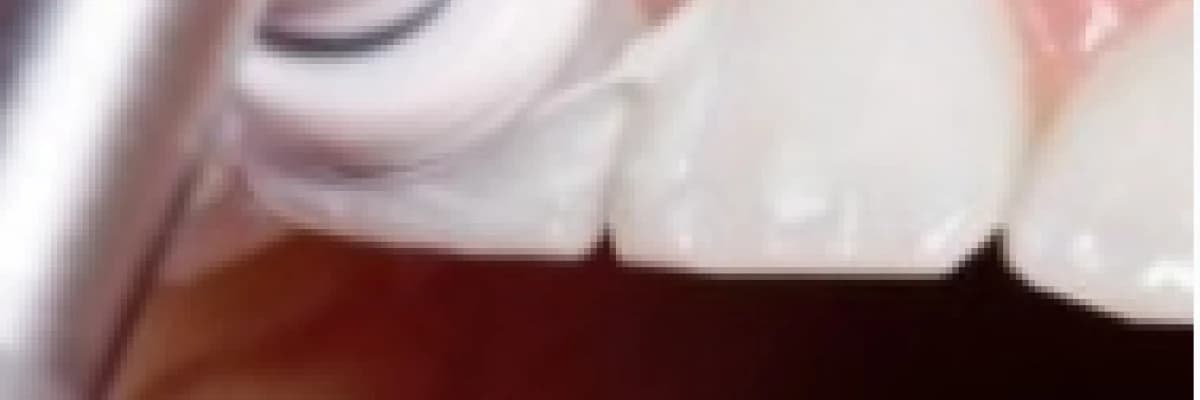 Diş Taşı Temizliğinin Dişlere Zararı Var mıdır?