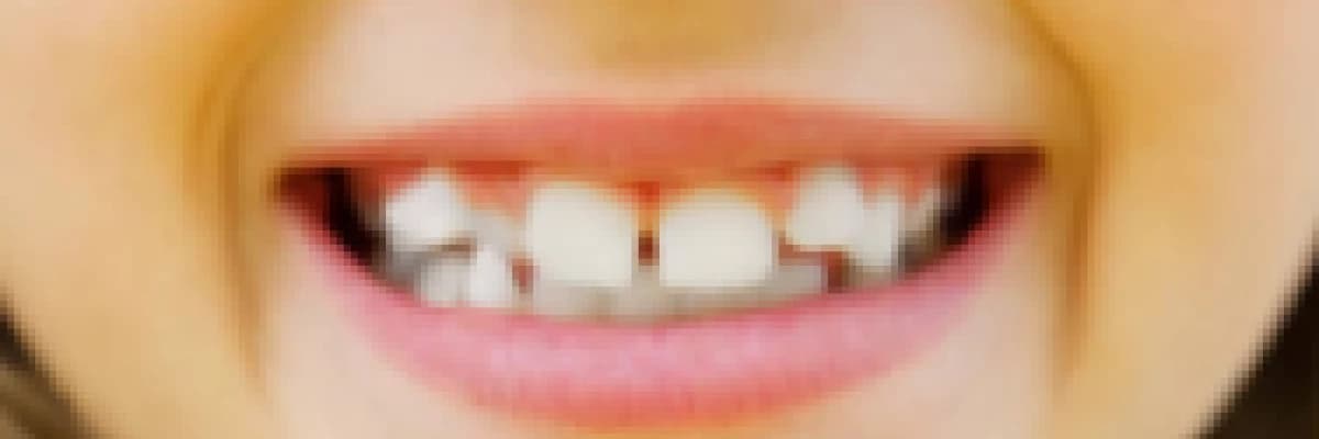 Dişlerin Çapraşık Çıkma Sebebi Nedir?