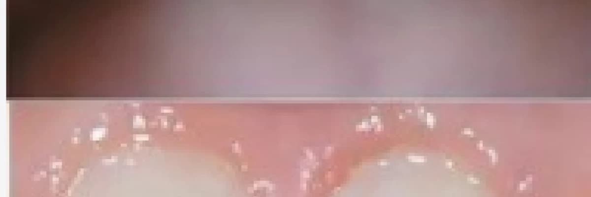 Bonding (Dental Bonding)