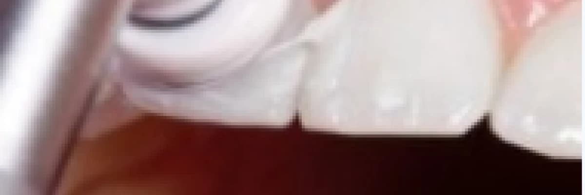 Diş Taşı Temizliği (Detartraj)