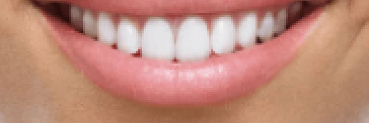 Gülüş Tasarımı (Altın Oran)