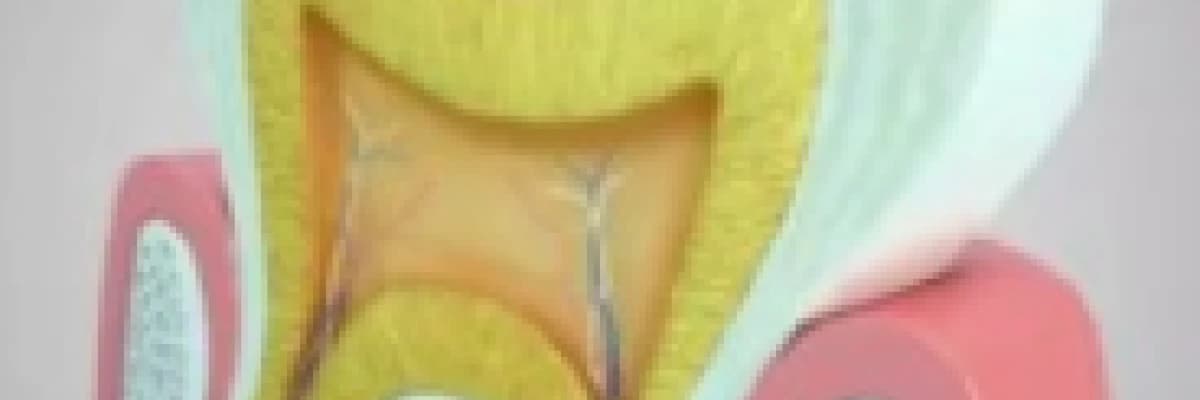 Kanal Tedavisi (Endodonti)