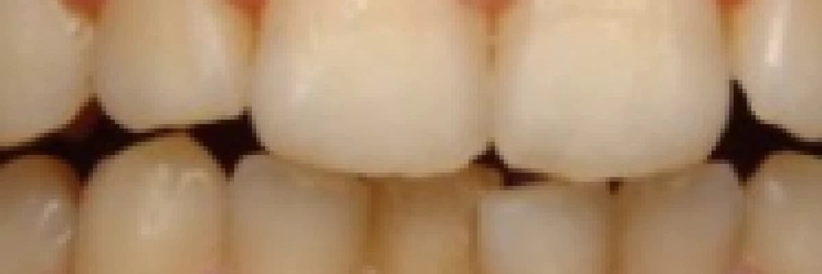 Diş Eti Hastalıkları, Diş Fırçalama Tekniği (Piyore)