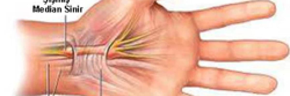 El bileği kanalında sinir sıkışması (Karpal Tünel Sendromu)