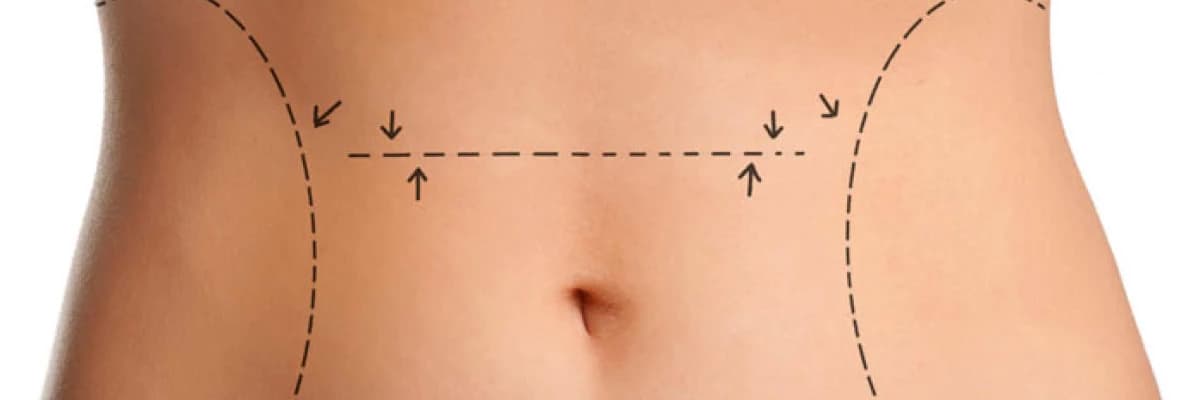 Karın Germe Ameliyatı Kimlere Yapılır?