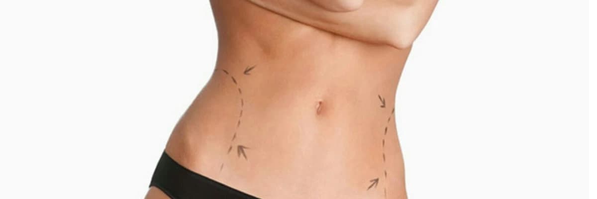 Karın Germe Ameliyatları herkese yapılabilir mi?