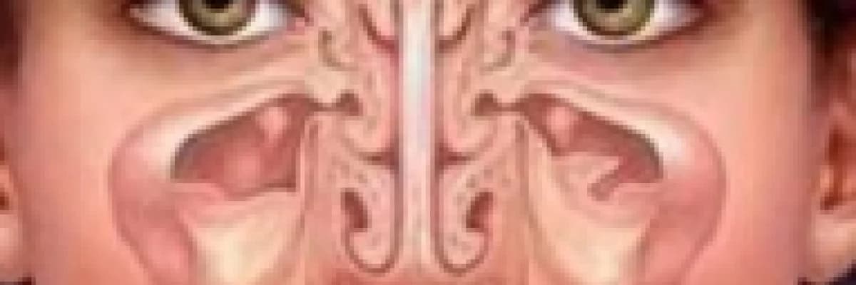 Sinüzit Nedir, Sebepleri Nelerdir ?