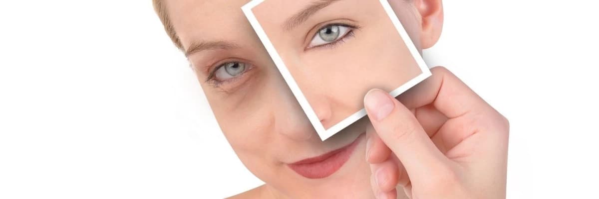 Göz altı Mezoterapisi