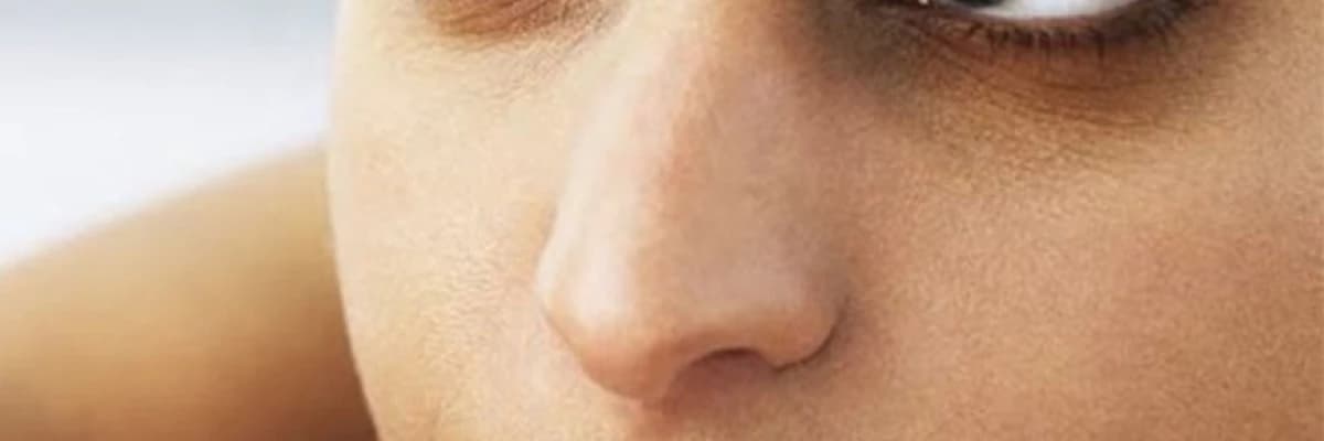 Göz Çevresi Morluğu Tedavisi Nedir?