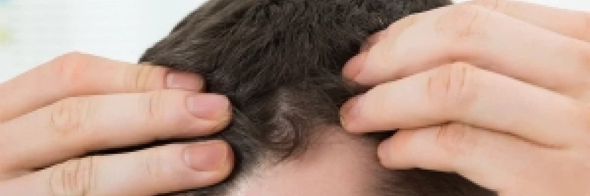 FUE Tekniği ile Saç Ekimi