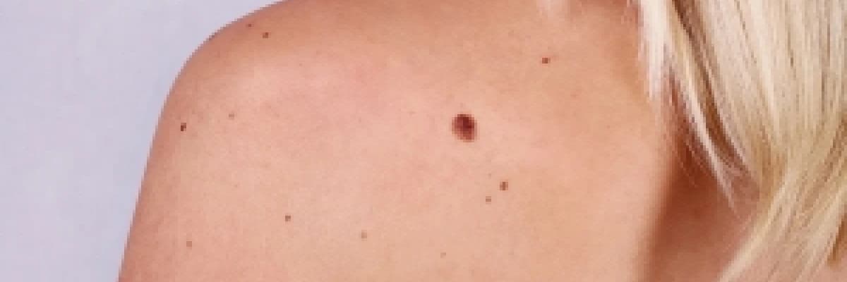 Deri Kanserleri / Melanom