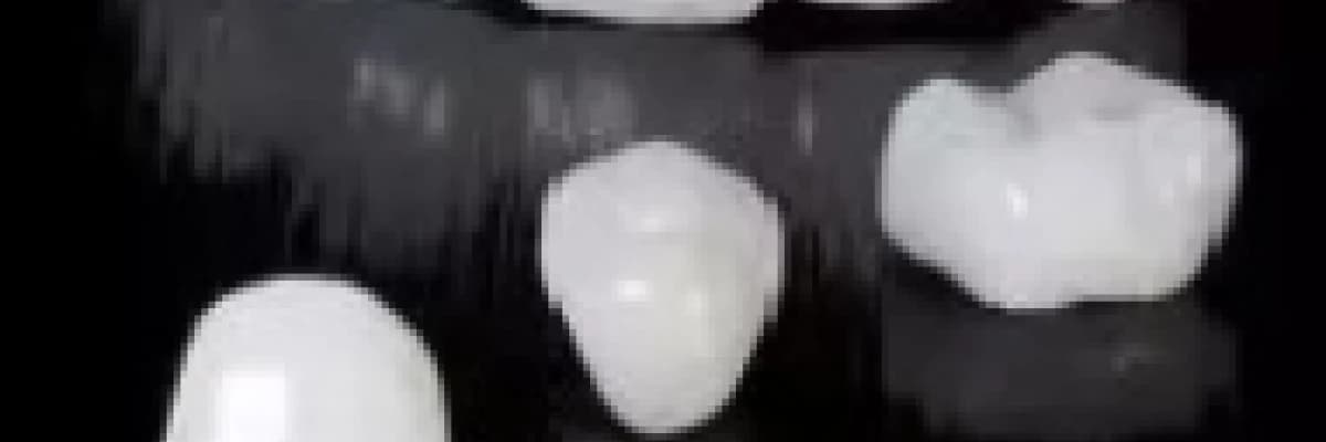 Zirkonyum porselen kaplama (empress porselen kuron)