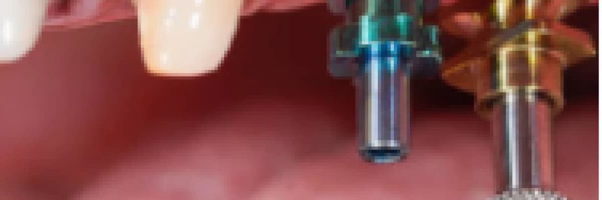 Implant nedir? Implant tedavisi ne kadar sürer? Herkes yaptırabilir mi? Vücut tarafından reddedilme riski var mıdır? Nelere dikkat etmek gerekir? Yapılan ımplant tedavisinin ömrü ne kadardır?