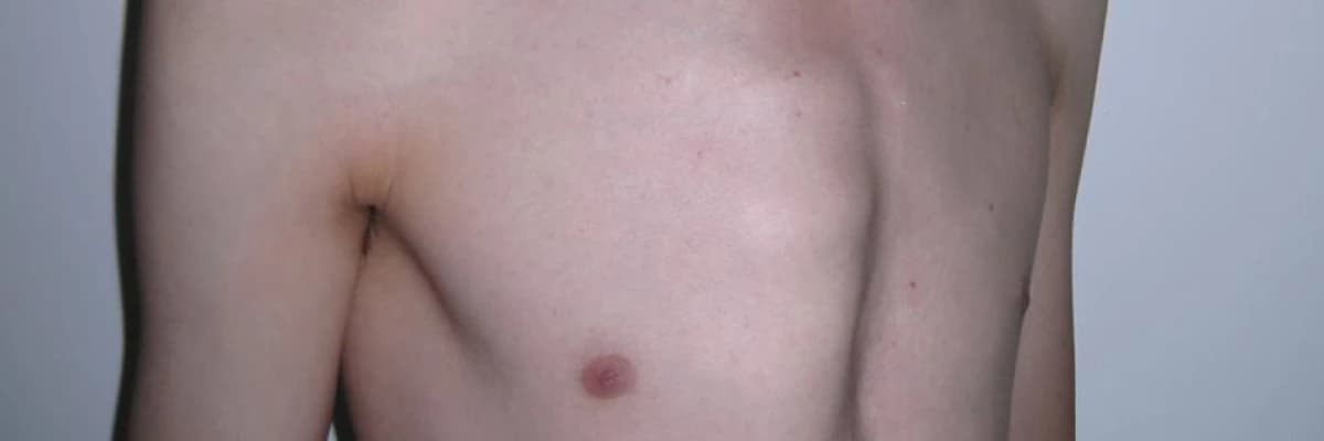 Göğüs Duvarı Deformiteleri