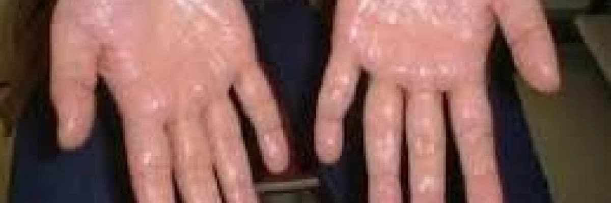 Hiperhidrozisde Cerrahi Tedavi