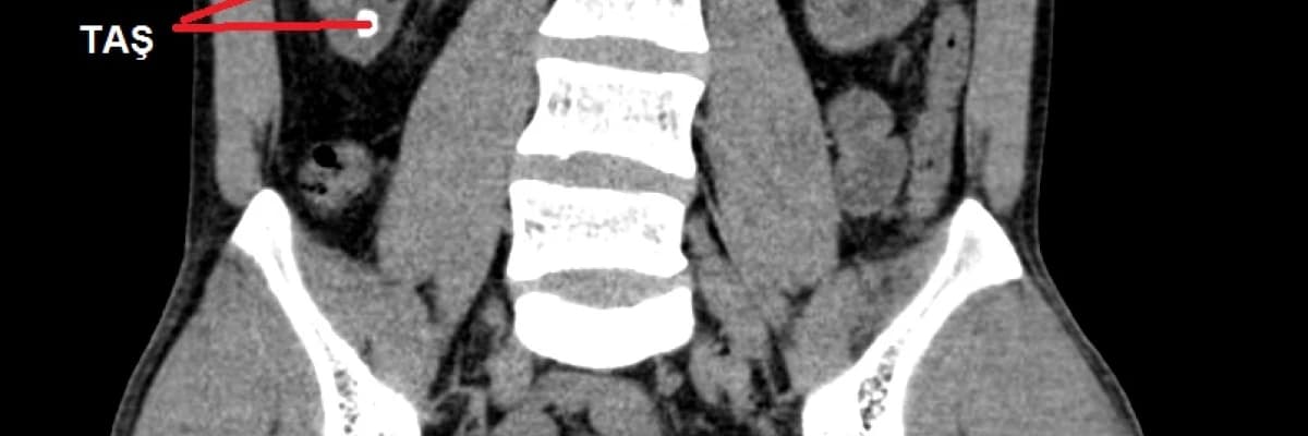 Böbrek Taşını en iyi gösteren film hangisidir?