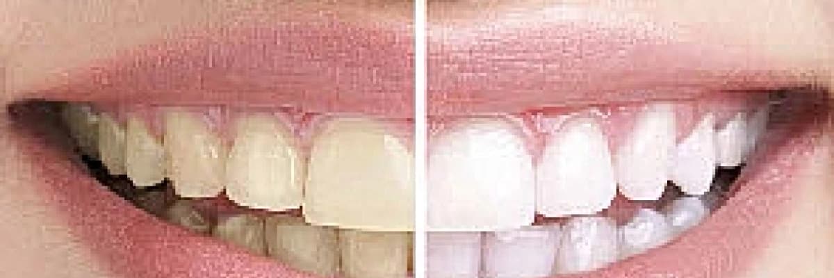 Diş Beyazlatma Hakkında Uygulama Yöntemleri