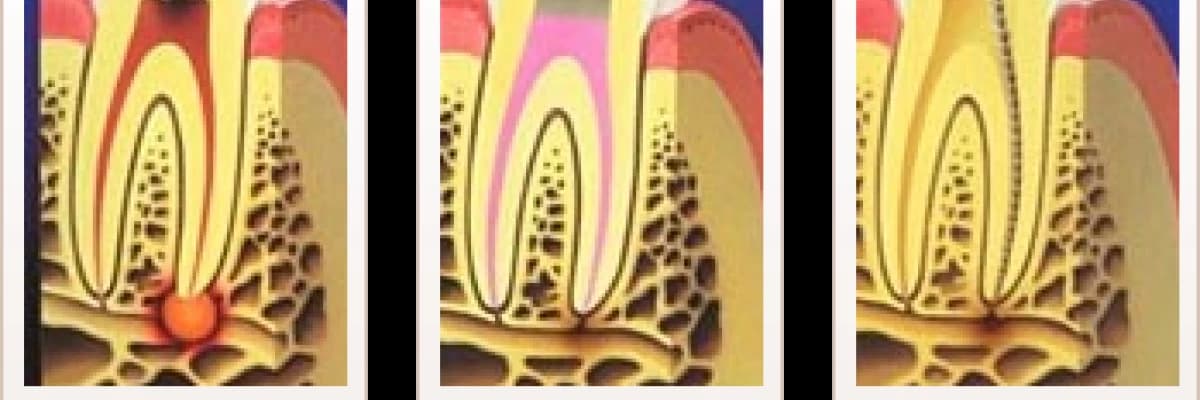 Kanal Tedavisine Neden İhtiyacım Var ?