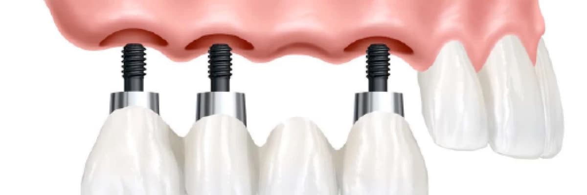 kısaca dental implant