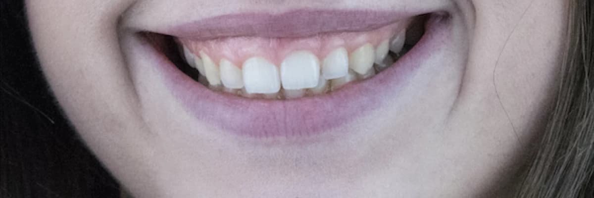 Gummy Smile (Dişetlerinin fazla görünmesi) ve Pembe Estetik Tedavisi