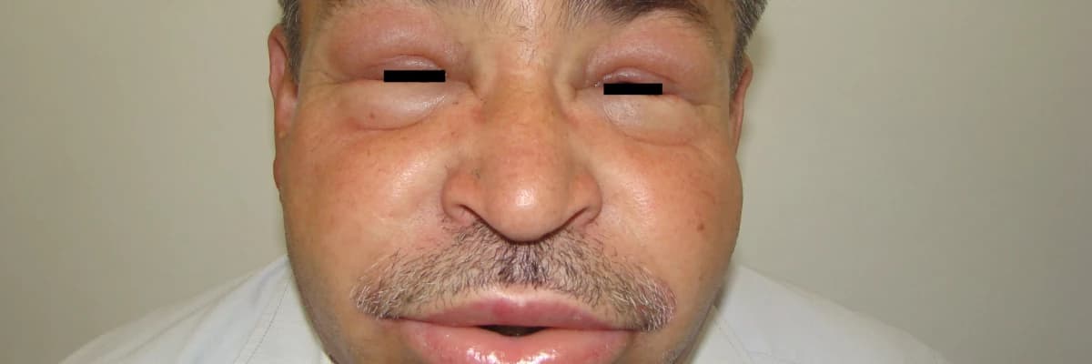 Allerjiyle karışan nadir bir hastalık: Herediter anjiyoödem