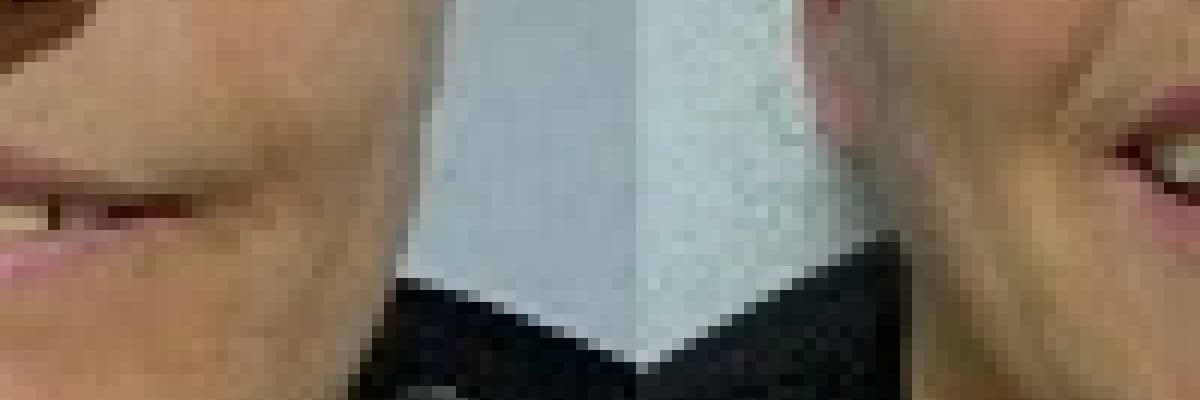 YÜZ FELCİ( PERİFERİK FASİAL PARALİZİ)