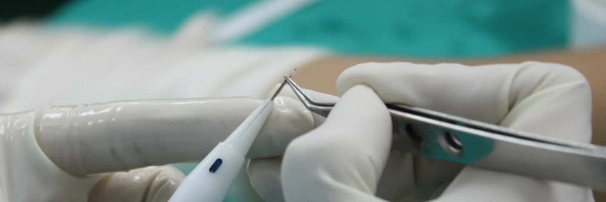 Kellik (Androgenetik alopesi) ve DHI ( Kalem tekniği) ile Saç ekimi