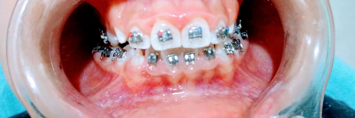 Ortodontik bozukluk nedenleri