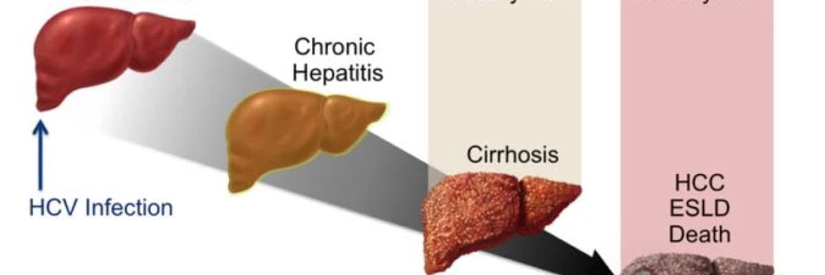 DİSPEPSİ NEDİR? (Şişkinlik, gaz, hazımsızlık)