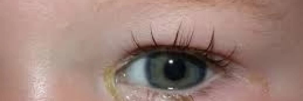 Bebeklerde göz sulanması, doğumsal göz yaşı kanal tıkanıklığı