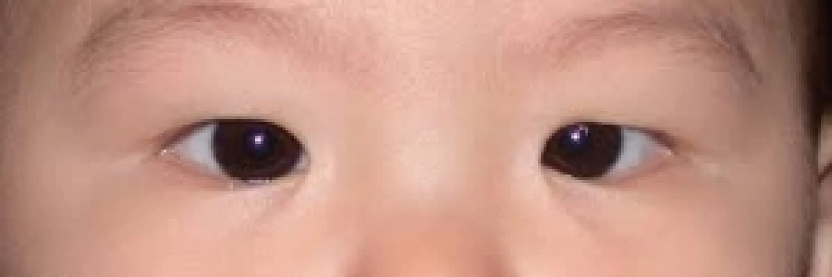 Bebeklik çağı göz kaymaları tipleri nelerdir? Yalancı şaşılık nedir?