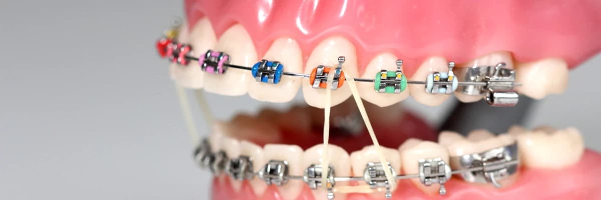 Ortotontik tedavi ve aşamaları