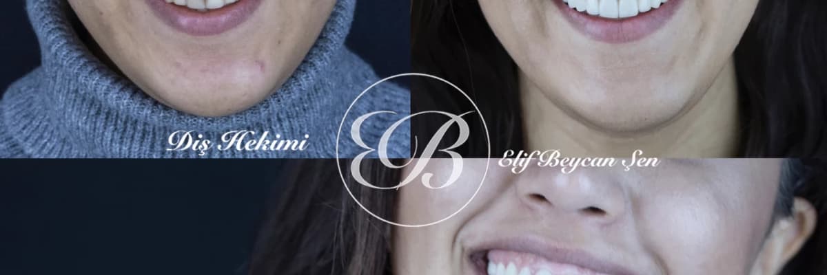 Gülüş tasarımı (smile design,gülüş estetiği) nedir?