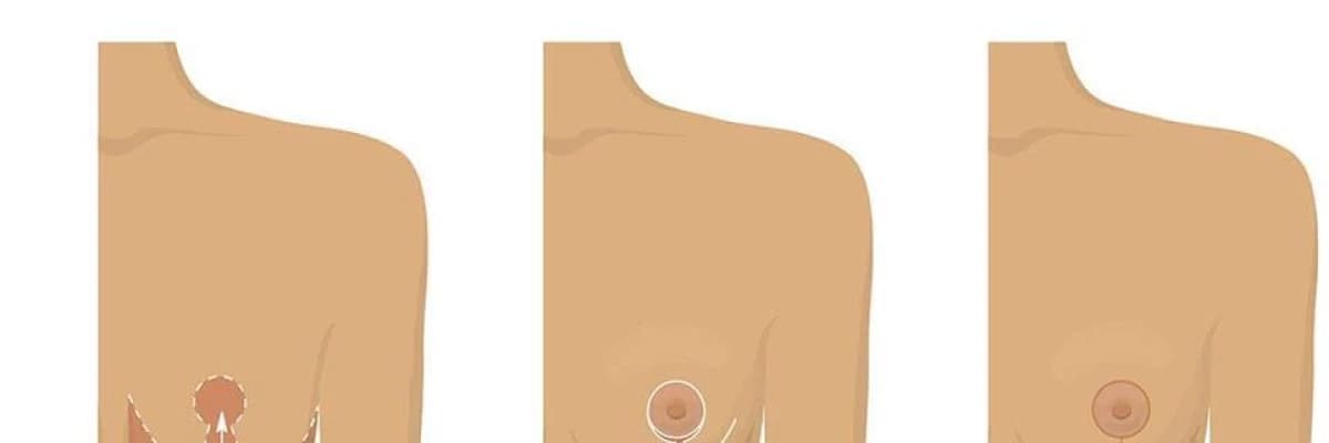 MEME KÜÇÜLTME AMELİYAT ÜCRETLERİ NASILDIR?