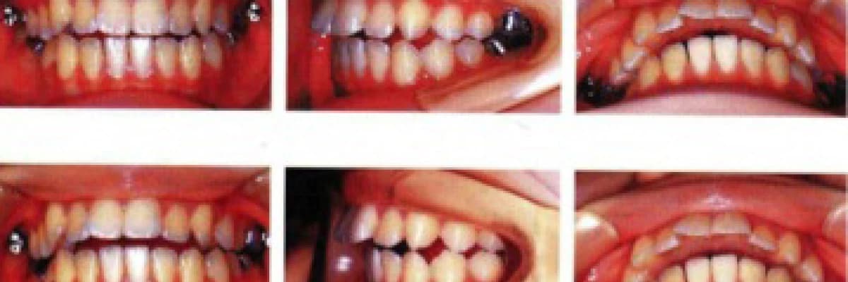 AMAN DİKKAT! ÇENE EKLEMİNDE UYGULANAN HER GECE PLAĞI MASUM DEĞİLDİR...