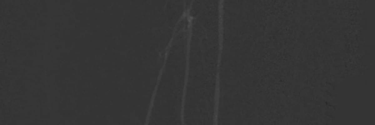 Karbondioksit Anjiyosu, Böbrek Yetmezliği ve Alerji Hastalarına Avantaj Sağlıyor