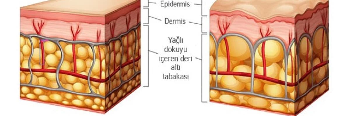 SELÜLİT NEDİR? NEDEN OLUŞUR?